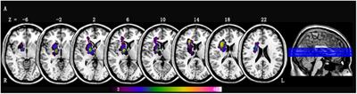 Dynamic Alterations in Spontaneous Neural Activity in Multiple Brain Networks in Subacute Stroke Patients: A Resting-State fMRI Study